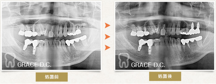 歯根破折部位へインプラント埋入を行った症例