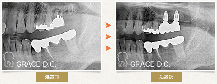 歯根破折部位へインプラント埋入を行った症例