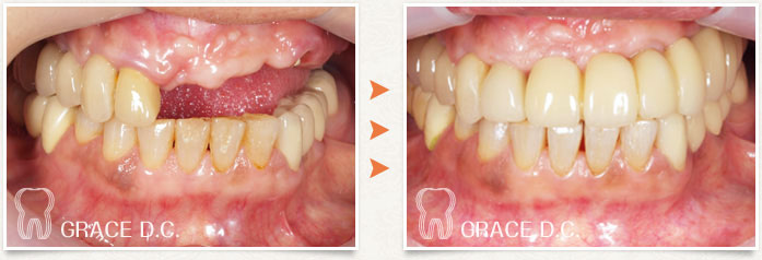 インプラント治療③:正面