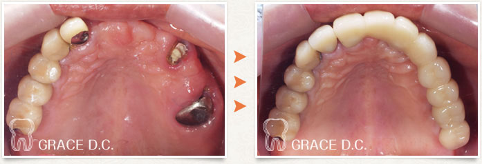 インプラント治療③