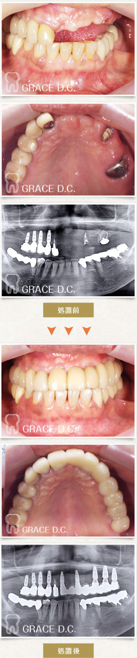 インプラント治療③