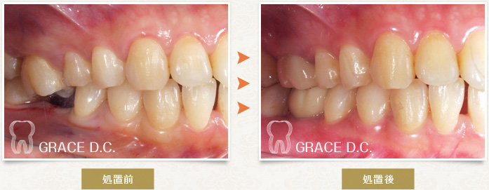 インプラント治療6