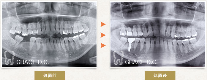 インプラント治療6：パノラマ