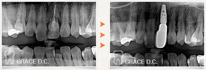 歯根破折部位へインプラント埋入を行った症例