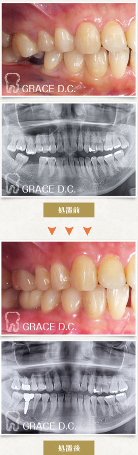 インプラント治療6