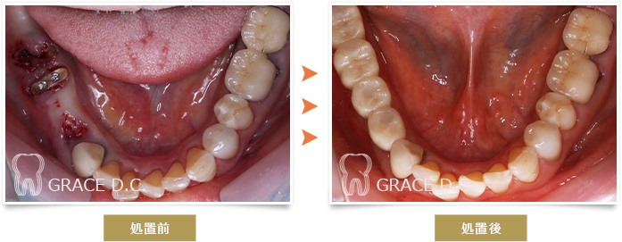 インプラント治療5
