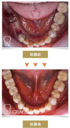 インプラント治療5