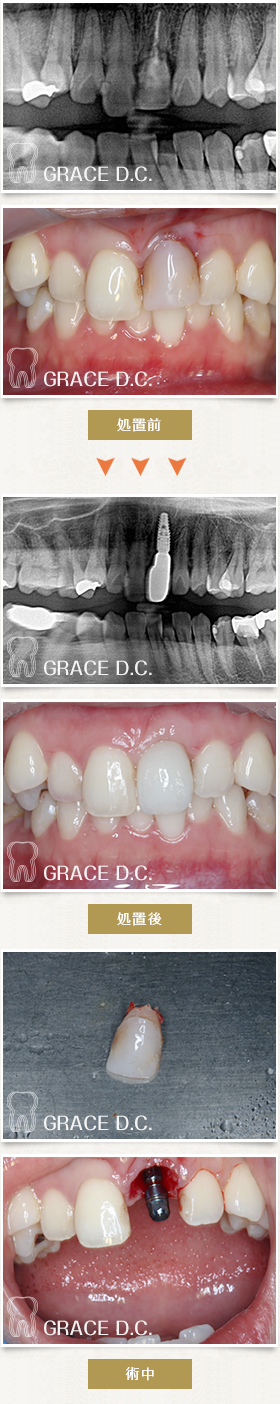 歯根破折部位へインプラント埋入を行った症例