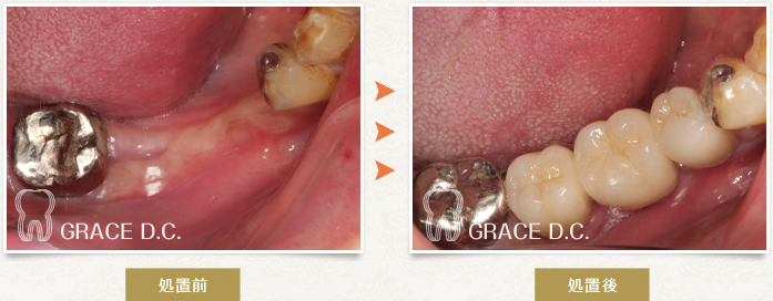インプラント治療⑫