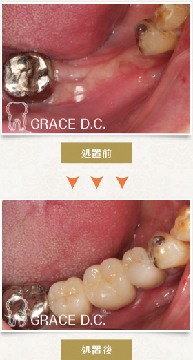 インプラント治療⑫：右下４番にインプラント