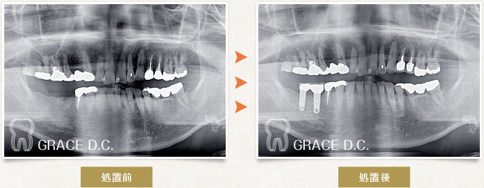 インプラント治療9：パノラマ