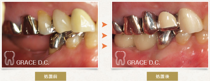 インプラント治療9