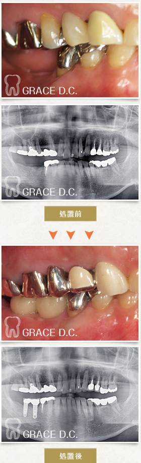 インプラント治療9