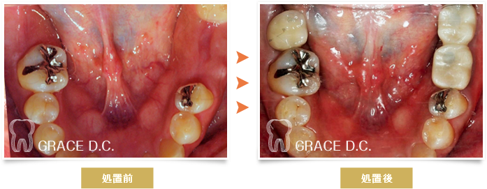 インプラント治療⑦