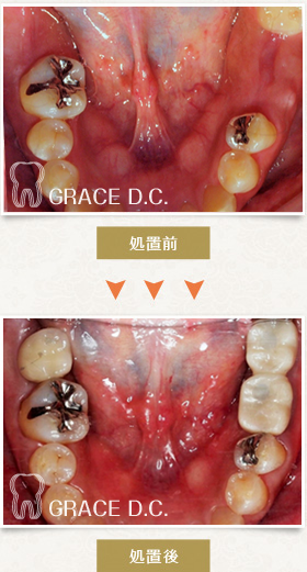 インプラント治療⑦