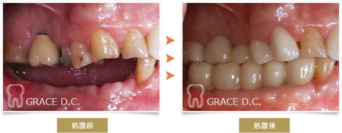 インプラント治療3