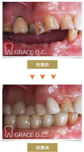 ンプラント治療3