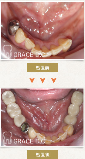 インプラント治療⑤