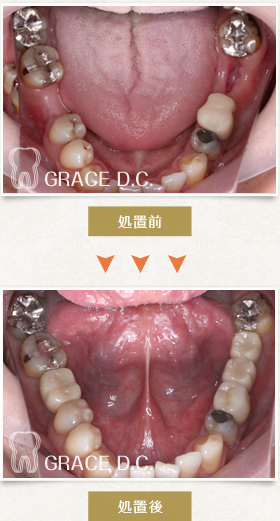 インプラント治療⑥