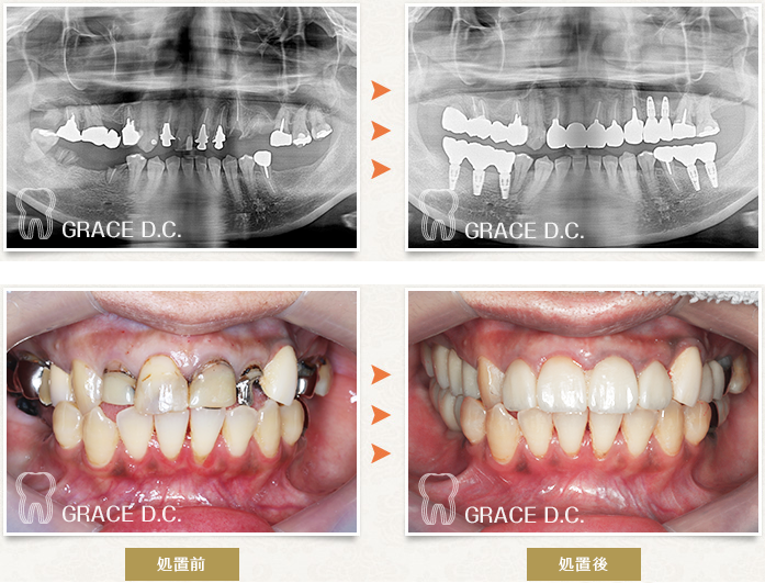ジルコ二アセラミックによる修復、インプラント埋入を行った症例