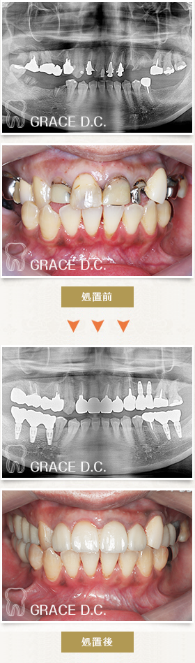 ジルコ二アセラミックによる修復、インプラント埋入を行った症例