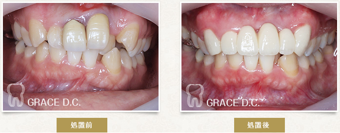 ジルコニアクラウンの被せ物で歯並びの改善