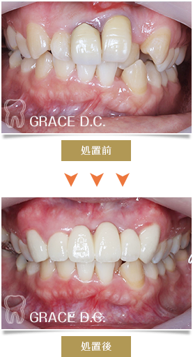 ジルコニアクラウンの被せ物で歯並びの改善
