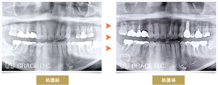 インプラント治療4：パノラマ