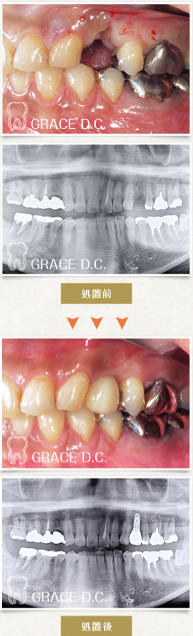 4インプラントによる咬み合せの修復