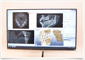 歯科用CT