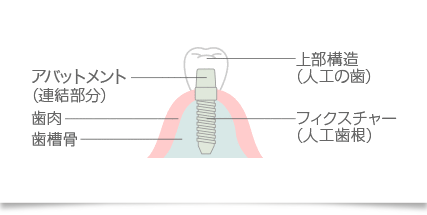 インプラントの写真