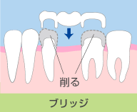 ブリッジ