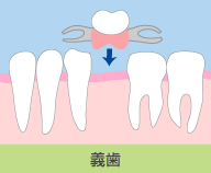 義歯（入れ歯）