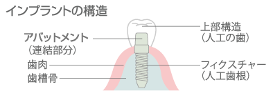 インプラントの構造