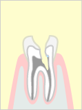 むし歯の除去