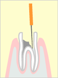 根管を徹底的に清掃<