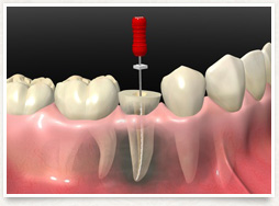 根管治療