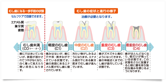 むし歯の進行