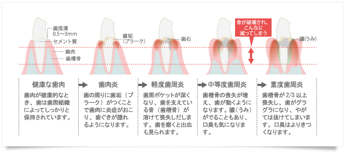 歯周病の進行